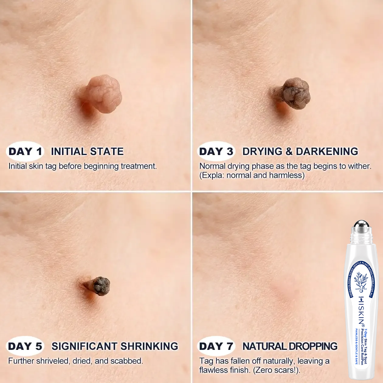 𝐇𝐈𝐒𝐊𝐈𝐍®✨ 𝟕-𝐃𝒂𝘆 𝐒𝗸𝐢𝐧 𝐓𝒂𝗴 & 𝐒𝐩𝙤𝐭 𝐄𝐫𝒂𝐬𝙚𝐫 Painless & Scar-Free Advanced Imperfection Removal Rollerball Pen