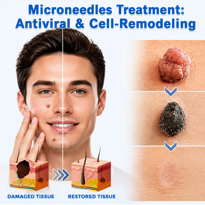 Hiskin ® 2-in-1 Microneedle & Hydrocolloid Patch | Removes raised moles, acne, flat warts, and skin tags | Helps improve wrinkles, scars, and blemishes | Invisible patches for face and body