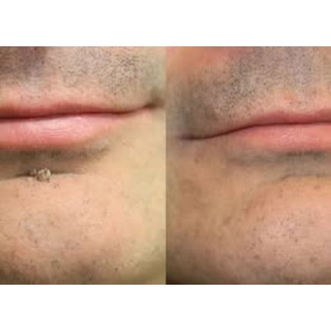 Hiskin ® 2-in-1 Microneedle & Hydrocolloid Patch | Removes raised moles, acne, flat warts, and skin tags | Helps improve wrinkles, scars, and blemishes | Invisible patches for face and body