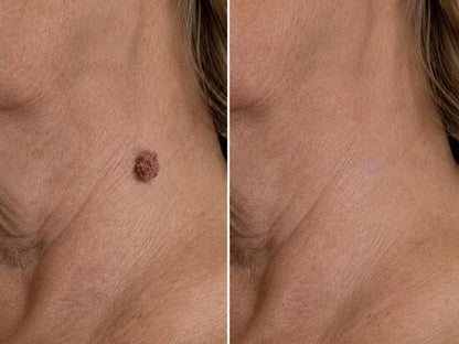 Hiskin ® 2-in-1 Microneedle & Hydrocolloid Patch | Removes raised moles, acne, flat warts, and skin tags | Helps improve wrinkles, scars, and blemishes | Invisible patches for face and body