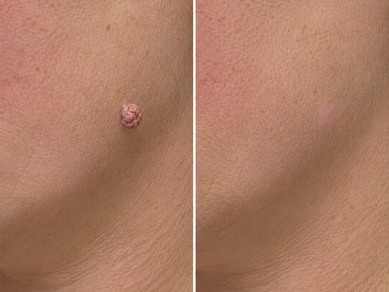 Hiskin ® 2-in-1 Microneedle & Hydrocolloid Patch | Removes raised moles, acne, flat warts, and skin tags | Helps improve wrinkles, scars, and blemishes | Invisible patches for face and body